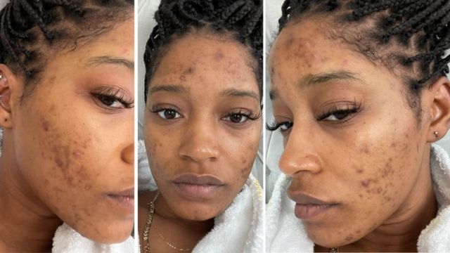 PCOS Survival: Treating Your Skin