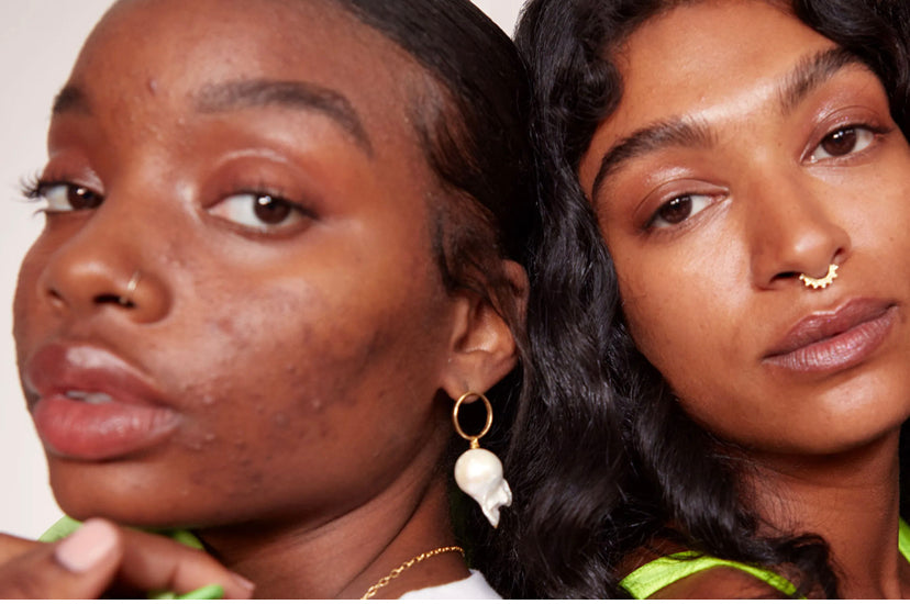 Hyperpigmentation and How to Treat It