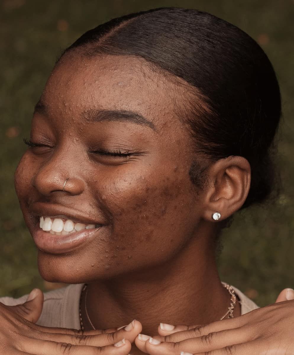 3 of The Most Common Teen Skin Conditions and How To Treat Them