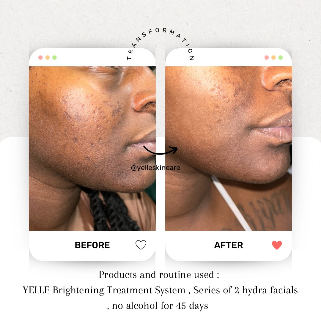 Dark Spots vs Hypermentation: Understand The Difference & How To Treat ...