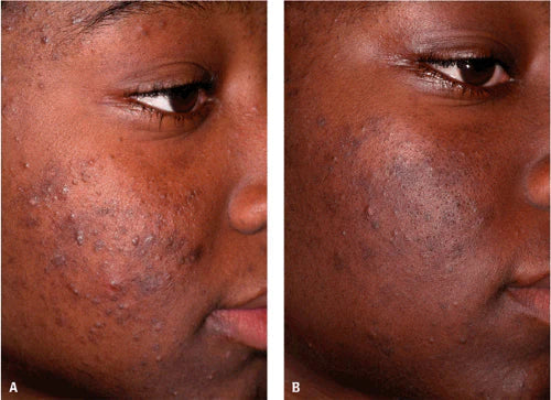 Dark Spots vs Hyperpigmentation: What’s the Difference + How to Treat ...